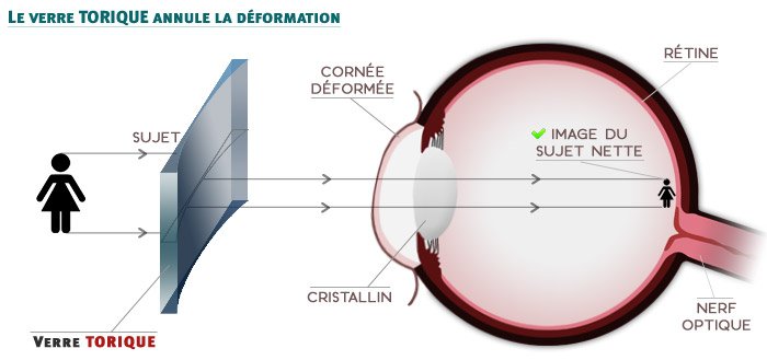 L'astigmatisme - Le verre torique annule la déformation